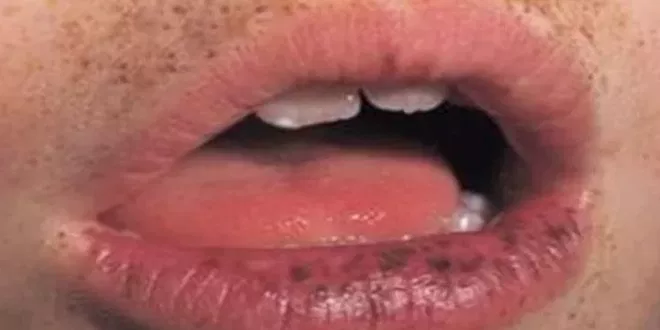 Dark spots on lips