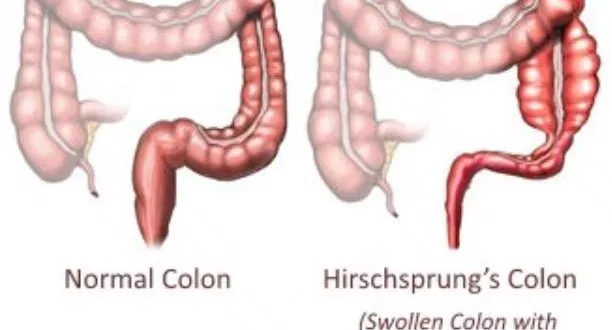 Swollen colon