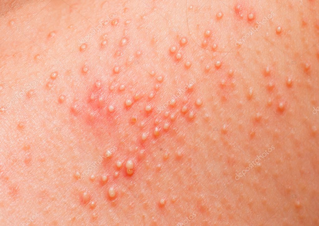 Genital herpes rash may appear as a blistering rash