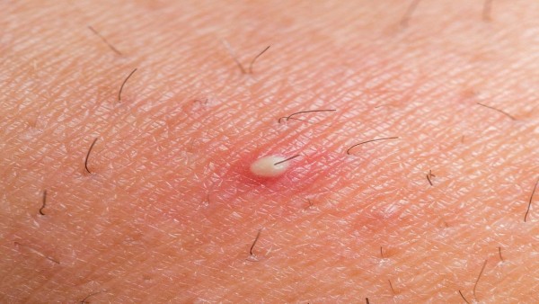 Ingrown-hair-cyst-on-pubic-area