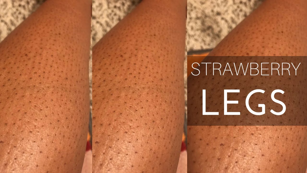 How to get rid of strawberry legs