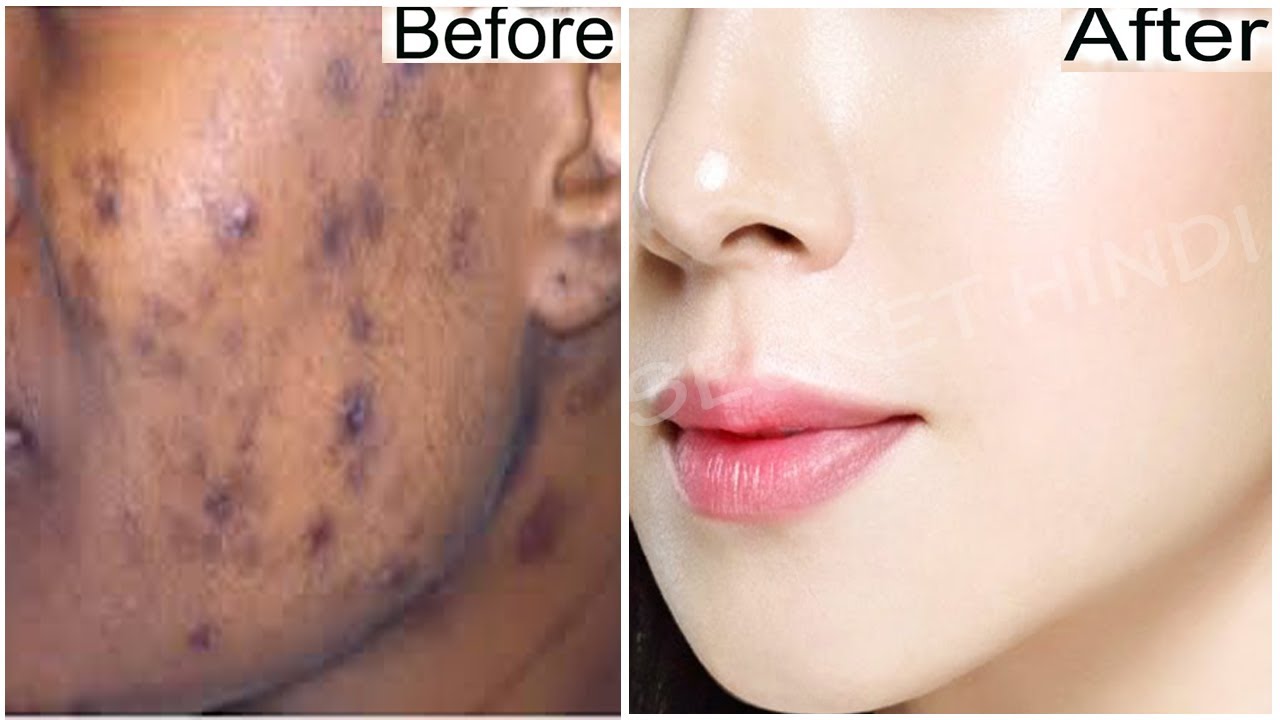 How to remove black spots on face in 3 days