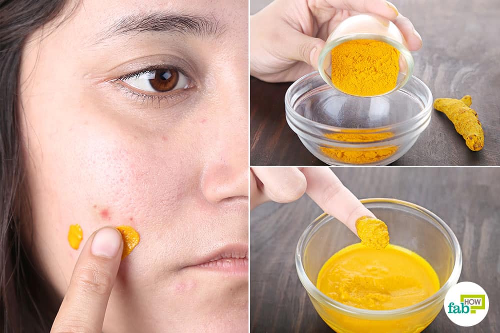 How to remove pimple marks fast, overnight with turmeric powder