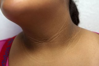Acanthosis nigricans and thigh chafing are known to produce similar symptoms