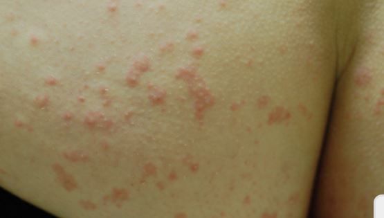 Itchy rash on buttocks from fungal infections