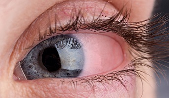 Ocular rosacea causing bumps on eyelids