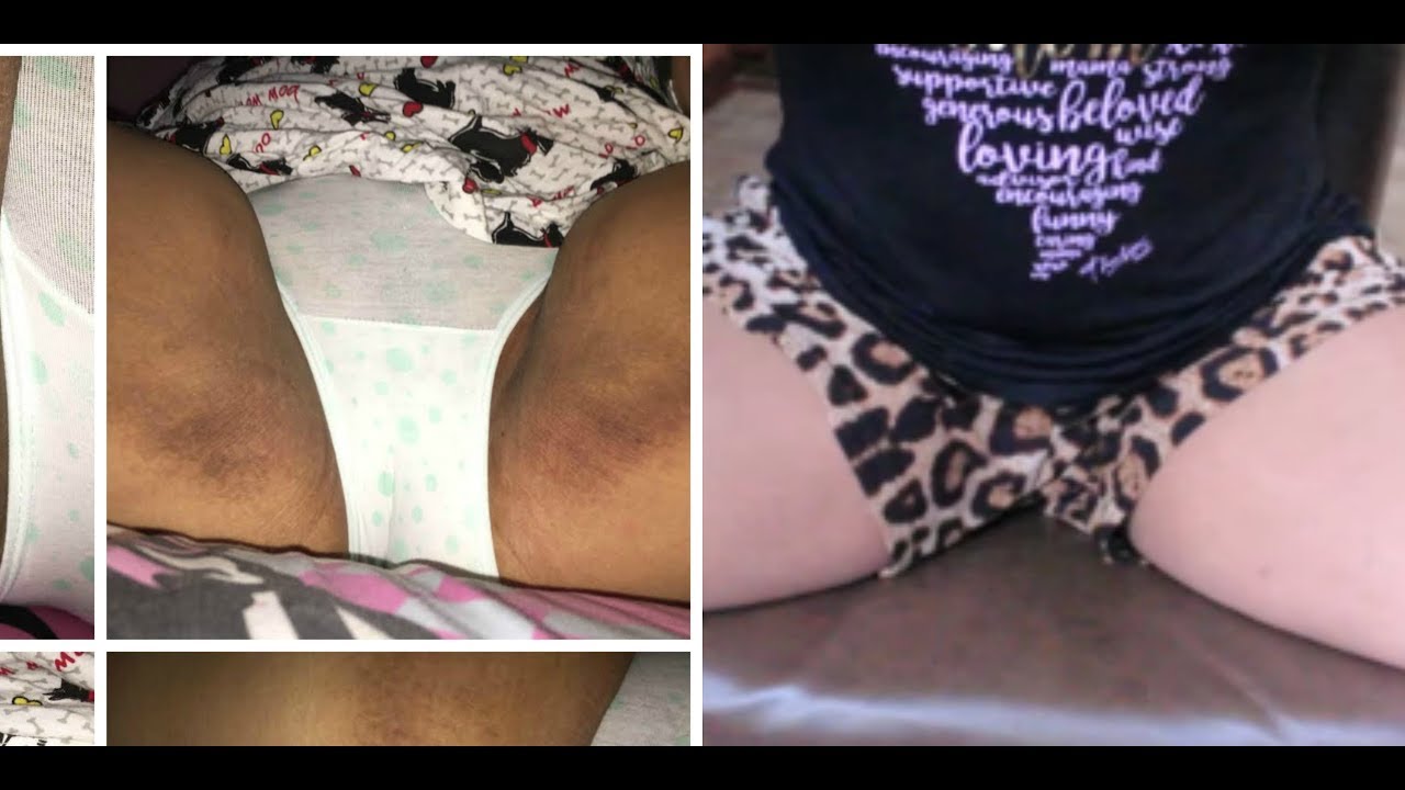 Pictures of dark skin between thighs