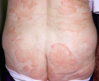 Pimply rash on buttocks pictures