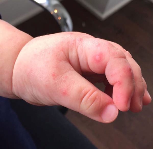 Red bumps on fingers and hands