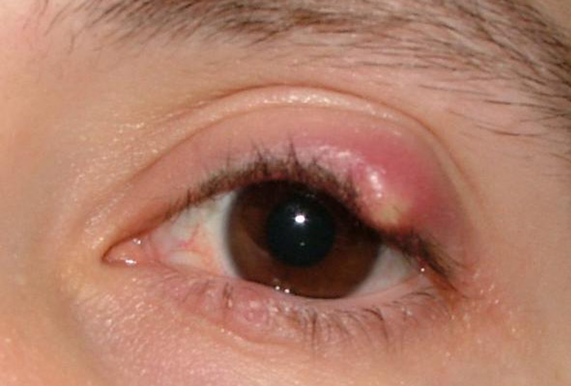 White-pimple-on-eyelid-or-upper-eyelid