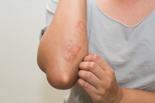 Bumps-on-elbows-or-elbow-rash
