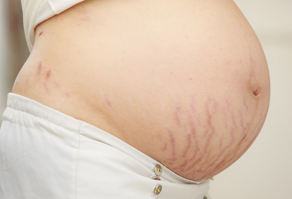 Purple stretch marks after pregnancy